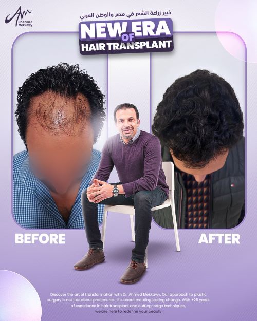 من هو افضل دكتور زراعة شعر في مصر؟